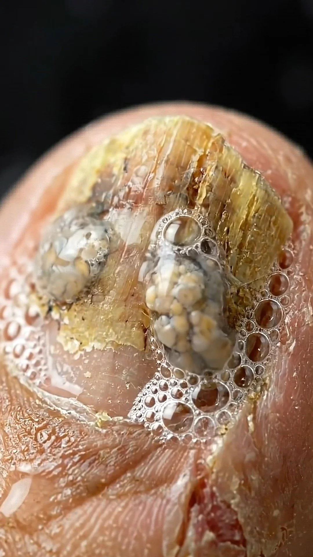 Preventing a fungal infection from getting worse with proactive measures.