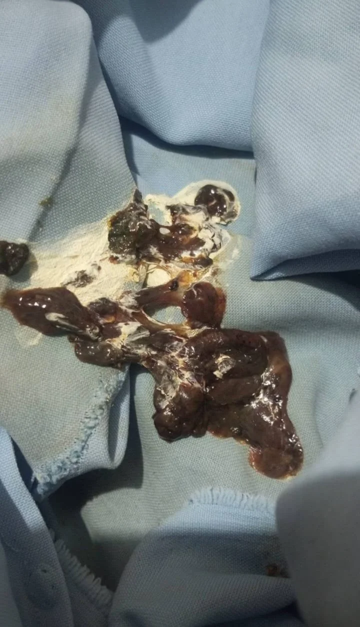 Discard Any Foreign Object Found in Chicken Immediately 1 A person inspecting chicken for foreign object contamination.