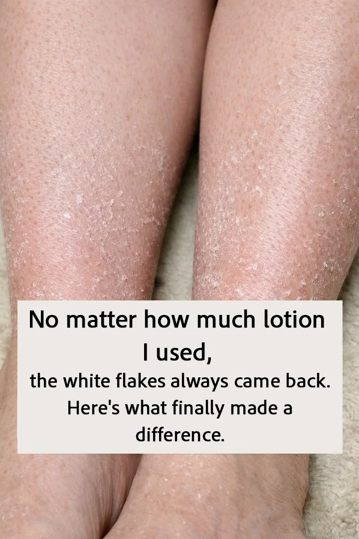 I Finally Stopped White Flakes from Dry Skin 1 Effective solutions for dry skin and white flakes removal