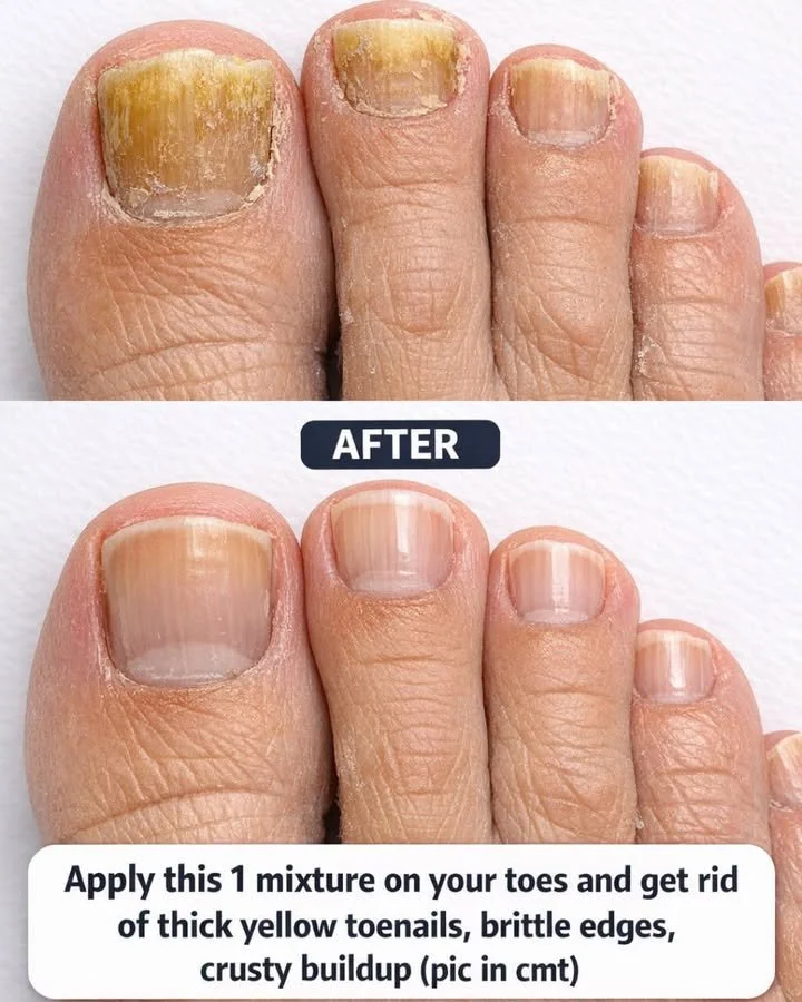 One-Mixture Toe Treatment to Remove Thick Yellow Toenails, Brittle Edges, and Crusty Buildup 1 One-mixture toe treatment for thick yellow nails and crusty buildup