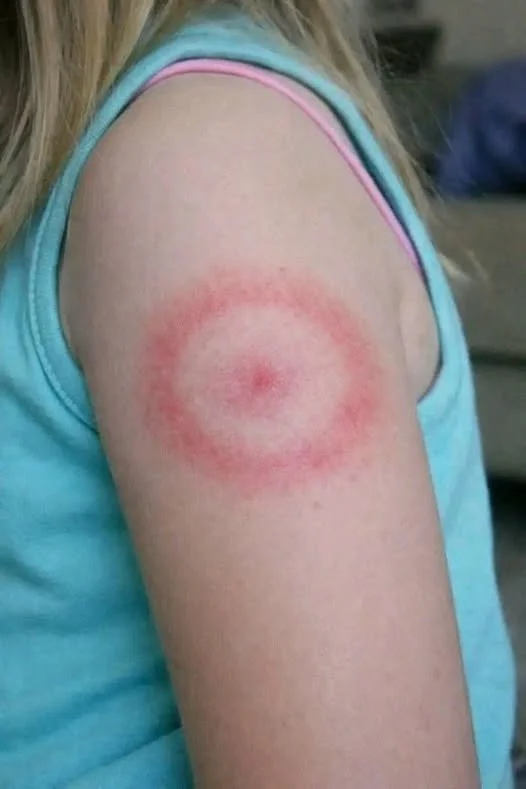 Child's arm showing a red ring-shaped rash, indicating a need for urgent care