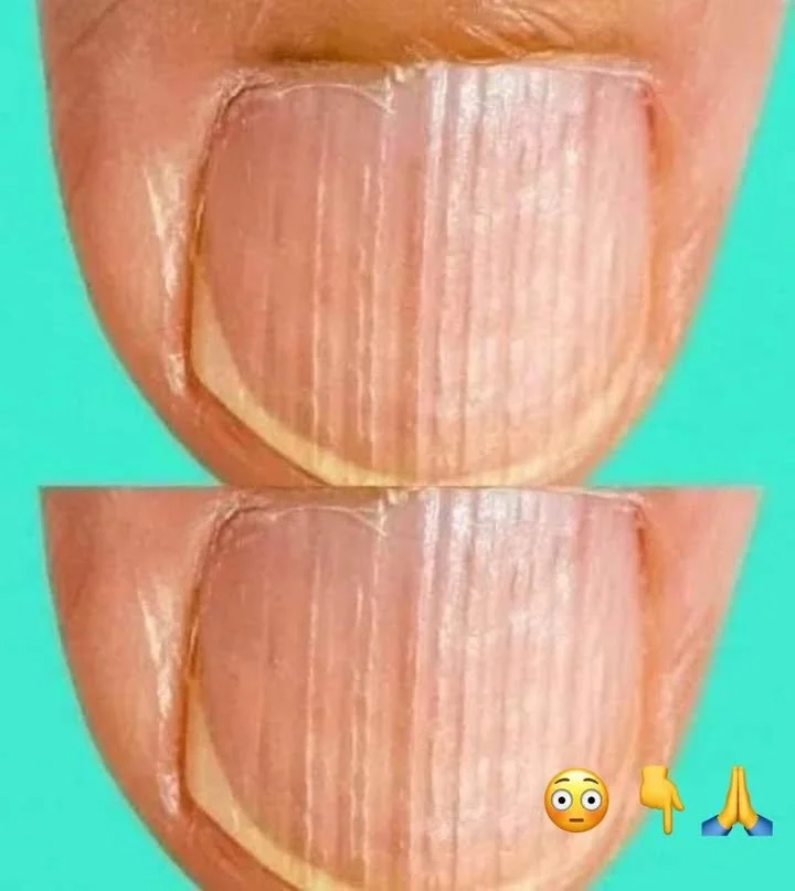 Visual of striped nails indicating potential health concerns.
